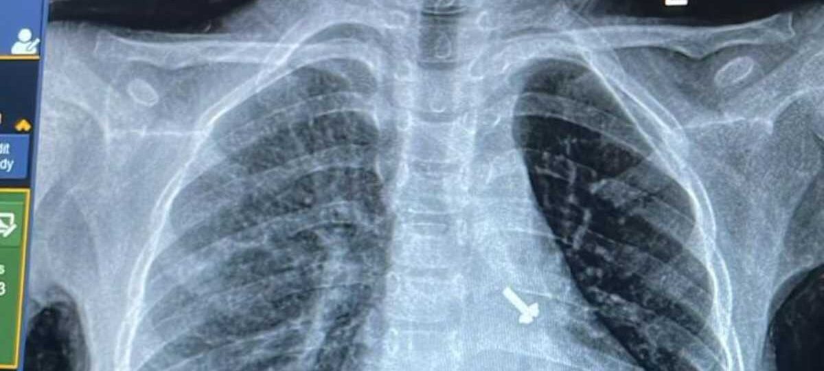 07 वर्ष के बच्चे के फेफड़े में फंसे पेंच को निकालकर एम्स के चिकित्सकों ने दिया जीवनदान