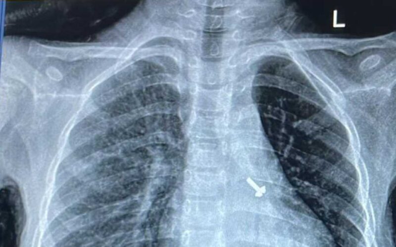 सात साल के बच्चे के फेफड़े में फंसे पेंच को निकालकर एम्स के चिकित्सकों ने दिया जीवनदान