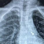 07 वर्ष के बच्चे के फेफड़े में फंसे पेंच को निकालकर एम्स के चिकित्सकों ने दिया जीवनदान